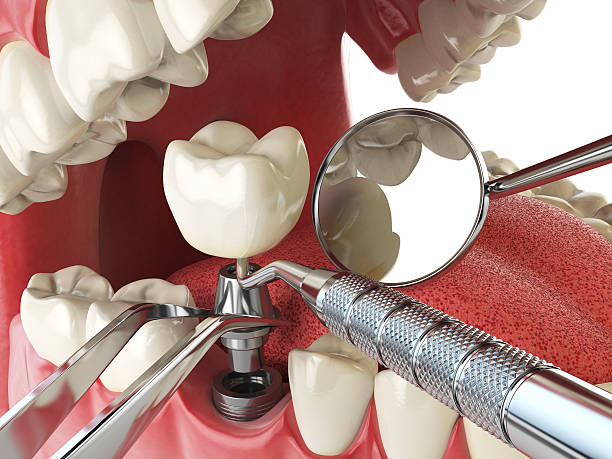 Best Urgent Tooth Repair  in Woodsboro, MD